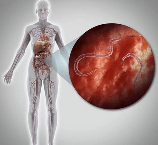 Parasites dans le corps humain